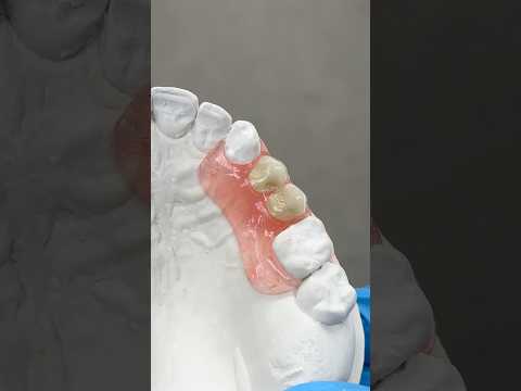 Double Premolar Partial #lsk121shorts #dentist #teeth