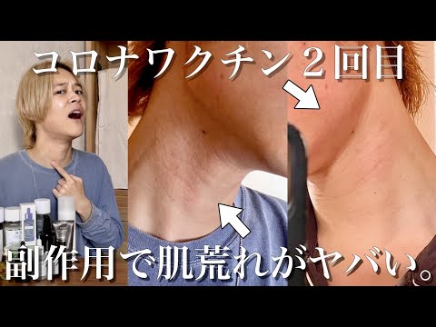 【コロナワクチン２回目】副作用で肌荒れがヤバい。『 20代男性 』