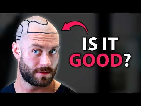 Chris Bumstead's Hair Transplant | Plastic Surgery Analysis