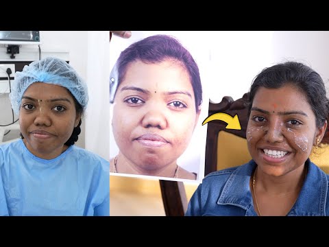 28-Year-Old Andhra Pradesh Woman’s Septorhinoplasty Surgery