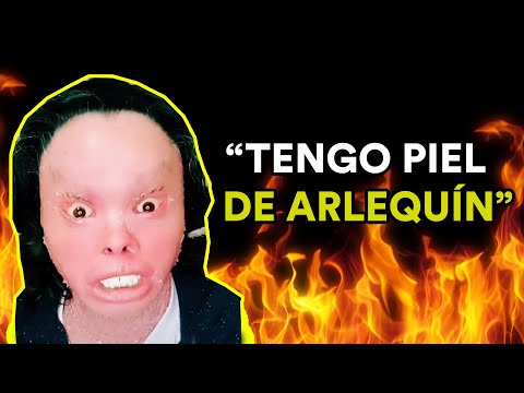 VIVIR CON PIEL DE ARLEQUÍN (Ictiosis en Arlequín)