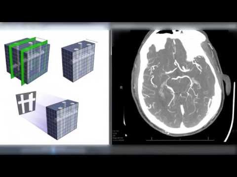 Maximum Intensity Projection (MIP) Reconstructions