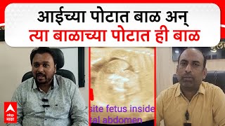 Buldhana Fetus in fetu : बुलढाण्यात 'फिटस इन फिटू'; त्या बाळाच्या पोटात ही बाळ