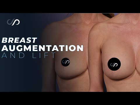 BEAUTIFUL Breast Augmentation after a Lift!