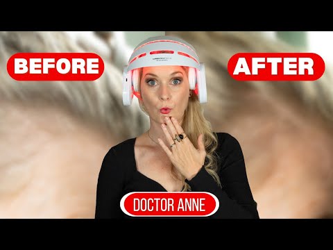 Does the CurrentBody LED Hair Growth Helmet Really Work? Doctor Anne’s 6-Month Review