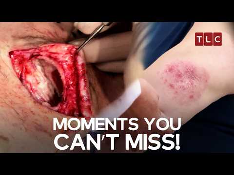 Jaw-Dropping Extractions from Dr. Pimple Popper! | Dr Pimple Popper TLC