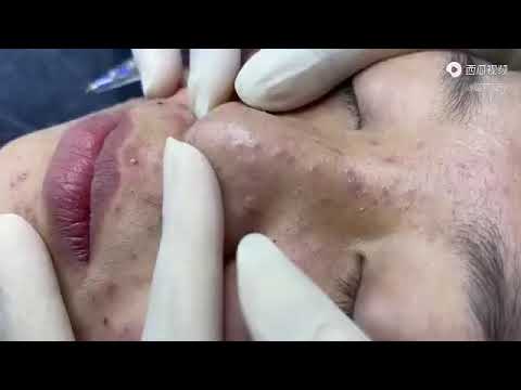 满脸粉刺，用力一挤大黑头现身！很治愈，解压。Squeeze acne, facial blackheads!