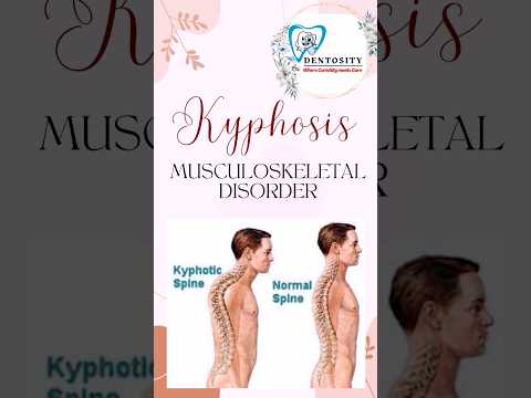 Unlock secret of kyphosis: Learn sign, symptom, diagnosis in just seconds! #HealthFacts #ViralShorts