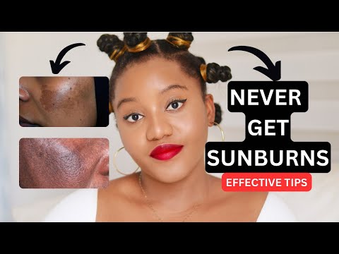 HOW TO TREAT AND GET RID OF SUNBURN & HYPERPIGMENTATION PERMANENTLY FOR A BRIGHT AN EVEN SKIN-TONE