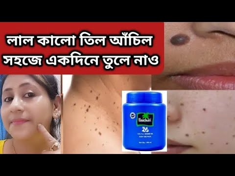 তিল ও আঁচিল একেবারেই দূর করার পাওয়ারফুল উপায়/Til dur korarUpay/RemoveTil,Mole,Warts,Masse Naturally