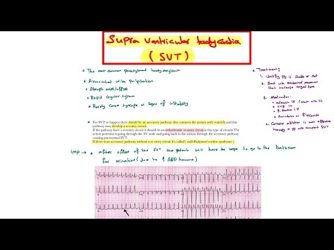 Supraventricular tachycardia , Multifocal atrial tachycardia