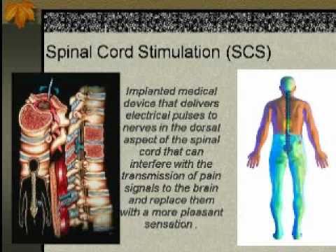 Spinal Cord Stimulators - Pt 1