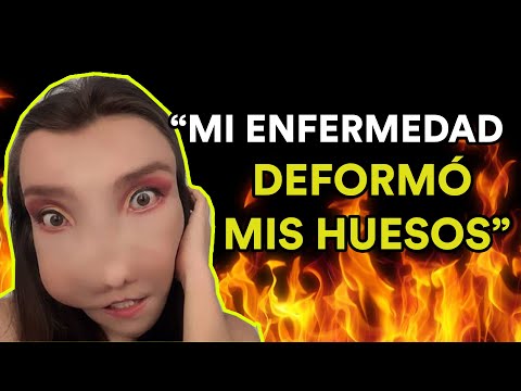 VIVIR CON DEFORMIDAD FACIAL (Entrevista a Leidy Ardila)