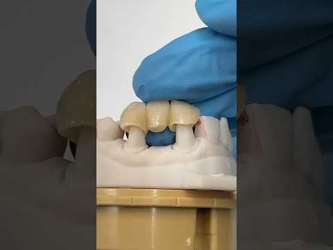 Upper Pontic Bridge #lsk121shorts #dentist #teeth