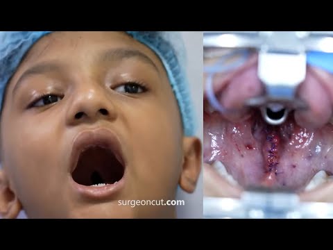 Speech & Secondary Palate Surgery for a Brave Boy