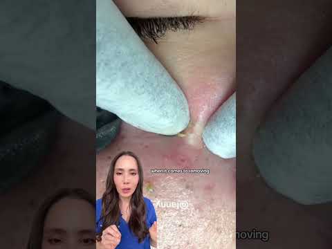 Satisfying Blackhead Extraction: Part I