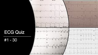 ECG Quiz #1 - 30