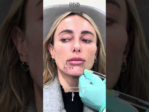 How To Downturned Mouth Using Filler - Before & After