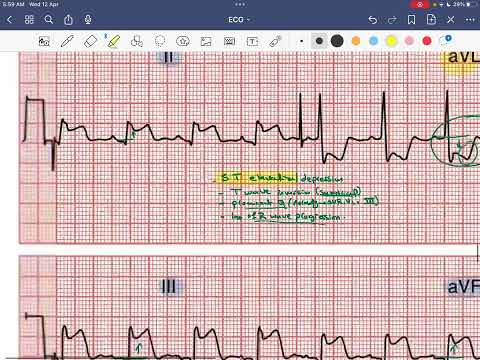 CASE_1 Acute inferior STEMI