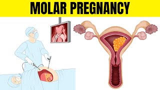 Molar Pregnancy (Hydatidiform Mole) - Types, Causes, Signs & Symptoms, Diagnosis, And Treatment