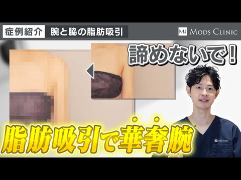 【症例紹介】二の腕と脇肉の脂肪吸引で一気により華奢に見える腕へ！/吉江秀和 医師｜Mods Clinic モッズクリニック（脂肪吸引・注入）