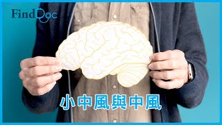 小中風和中風之間有關係嗎？－朱炎培腦神經科專科醫生＠FindDoc.com