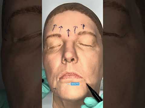 Doctor's Botox Face Lift Demo: How We Target Each Area! #botoxinjections #botox