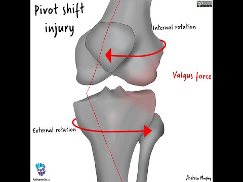 Contrecoup injury (ACL tear Valgus force)