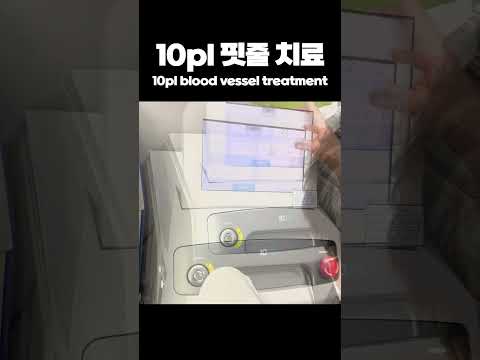 10pl 핏줄 치료 10pl blood vessel treatment