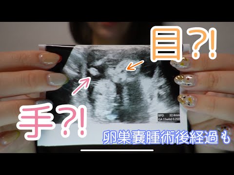 【卵巣嚢腫術後】良性？悪性？術後の経過・妊娠１５週目の経過！