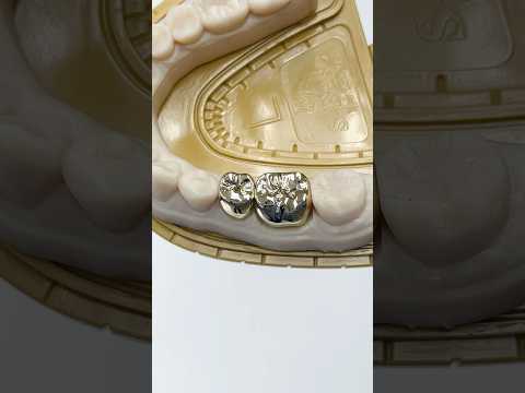 Two Posterior Gold Crowns #lsk121shorts #dentist #teeth