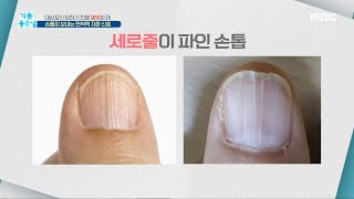 [기분 좋은 날] 대상포진 당하기 전에 예방하자! 손톱💅이 보내는 면역력 저하 신호🚨, MBC 210517 방송