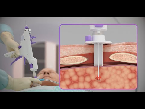 Prana Thoracic - Image-guided, Minimally Invasive surgery - 3D Medical Animation