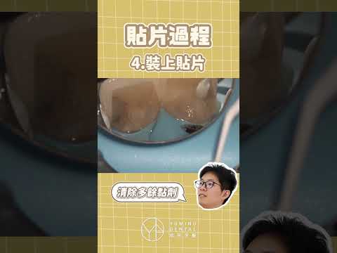 陶瓷貼片怎麼做？製作大公開：1分鐘快速解析｜【祐民牙醫－隱適美旗艦店】許四融醫師 (小許醫師) #陶瓷貼片 #美白牙齒 #祐民牙醫