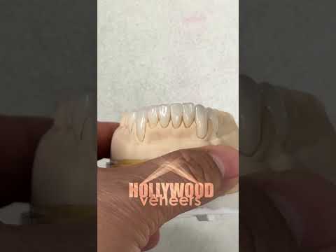 Take a look at these beautiful Hollywood Veneers that we made in my lab, LSK121 Oral Prosthetics