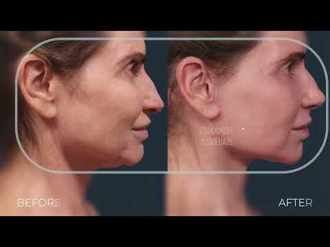 Beautiful Traceless Facelift Patient Spotlight | Dr. Stoker EXPLAINS