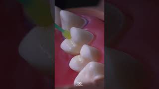 Overlay prep on a premolar. Step-by-step #overlay #dentistry #premolar