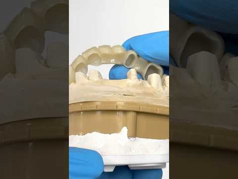 3-Pontic Bridge with Crowns #lsk121shorts #dentist #teeth