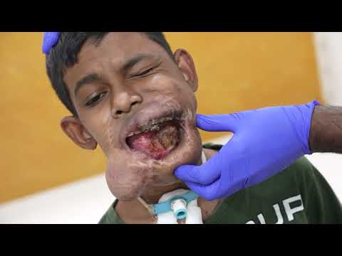 Hemangioma Surgery Consultation for a Young Boy