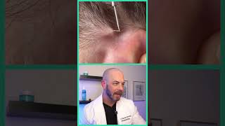 Derm reacts to MASSIVE ingrown hair! #dermreacts #doctorreacts #ingrownhair