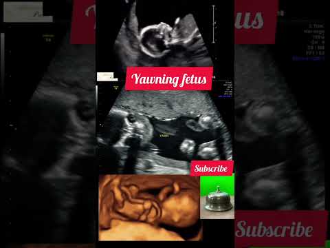 #heartbeat #pregnancy #shorts #shortsfeed #shortsvideo #viral #youtubeshorts @askyourdoctor2905