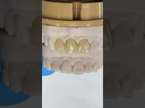 Correcting the previous teeth with Hollywood Ceramics #lsk121shorts #dentist #teeth