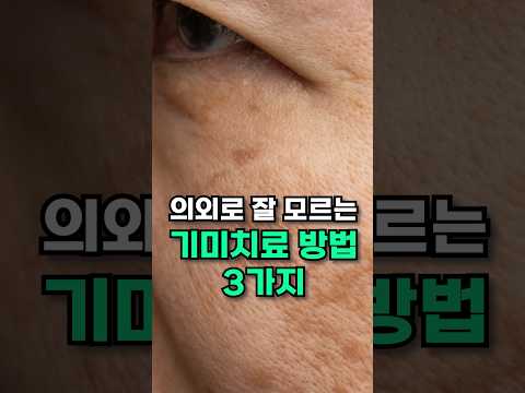 기미 레이저에 헛돈 쓰지 마세요. #기미없애는법 #기미잡티없애는법 #기미레이저