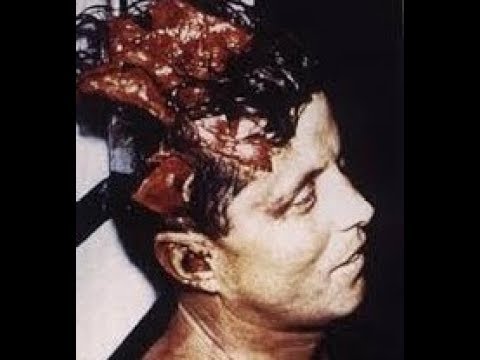 JFK file release new photo !!!! FRONT  SHOT ENTRANCE WOUND MISSING !!!!!