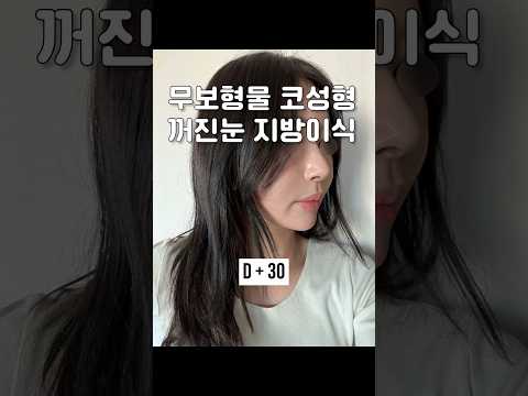 무보형물 코성형 & 꺼진눈 지방이식 당일~한달 후기 브이로그 #무보형물코수술 #무보형물코성형#눈꺼풀지방이식#눈두덩이지방이식#눈꺼짐지방이식#성형후기#성형브이로그 #antiaging