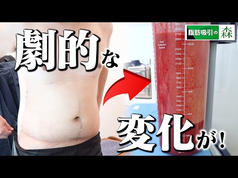 苦労してダイエット？お金はかかるけど脂肪吸引？【お腹の脂肪吸引】