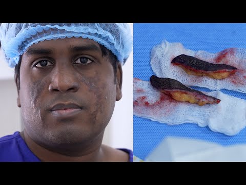 Scar Revision Surgery for Trauma Scars