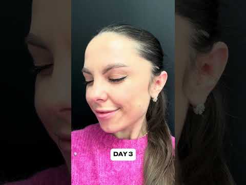 Botox Journey: See the WOW Results in Just Days - DrMedispa