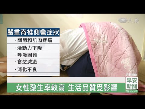 脊椎側彎女性發生率較高 生活品質受影響