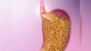 Acid Reflux Natural Remedies